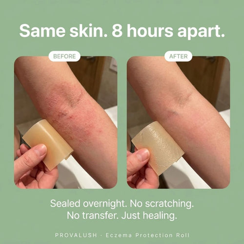 Eczema Protection Roll